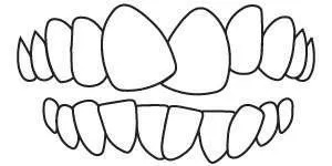 Dental diagram showing crowded teeth