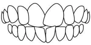 Dental diagram showing rotated teeth