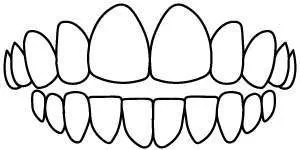 Dental diagram showing an open bite