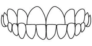 Dental diagram showing a crossbite