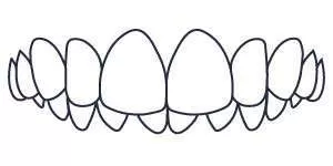 Dental diagram showing an overbite