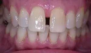 Close-up of front teeth with spacing
