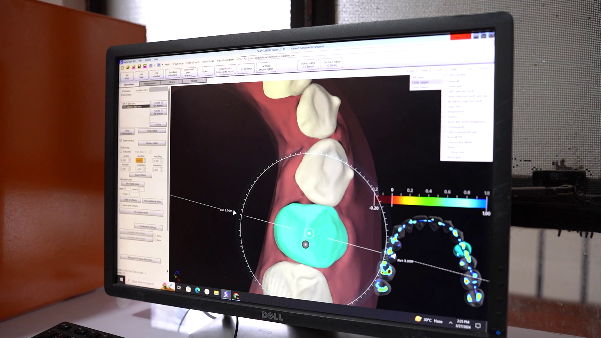 Discover the Benefits of 3D Treatment Planning with Clear Moves Aligners