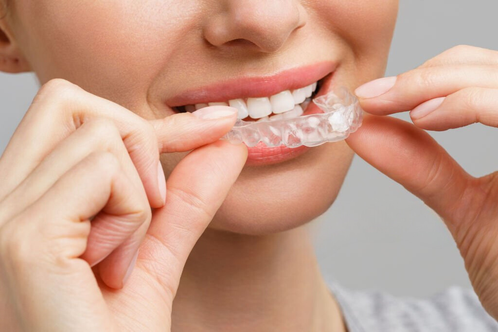 The Advantages of Custom Clear Aligners for Orthodontic Treatment