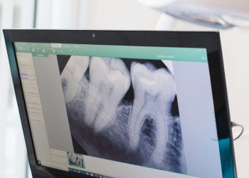 Close-up of a dental x-ray displayed on a monitor in a dental office.