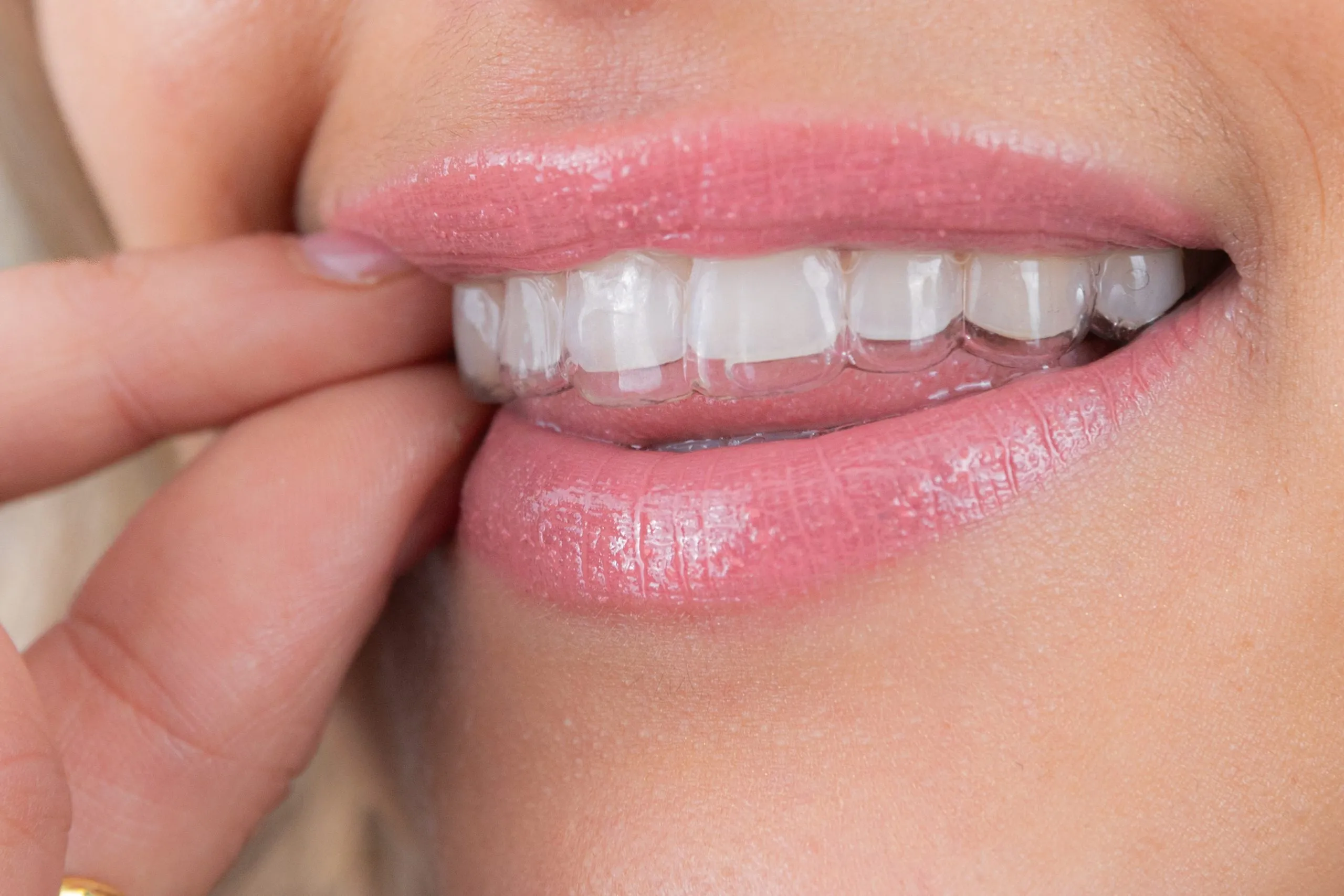 Woman wearing a transparent clear aligner
