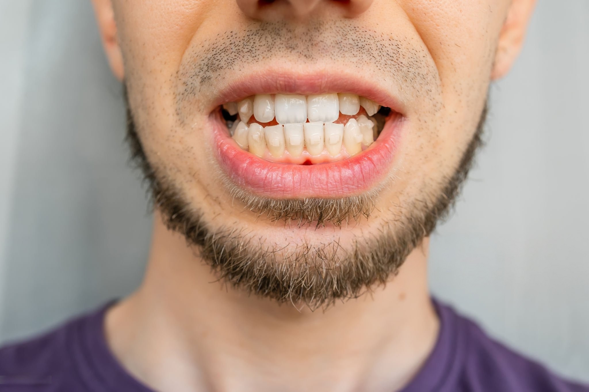 how clear aligners fix misaligned teeth