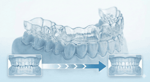 importance of multi layer clear aligners