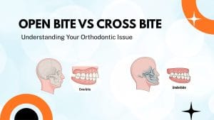 open bite vs cross bite clear aligners visual illustration