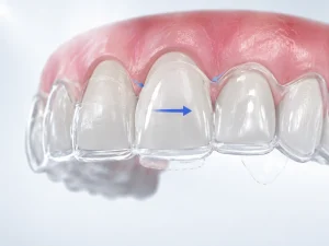 Tooth Movement Biomechanics in Clear Aligner Treatment