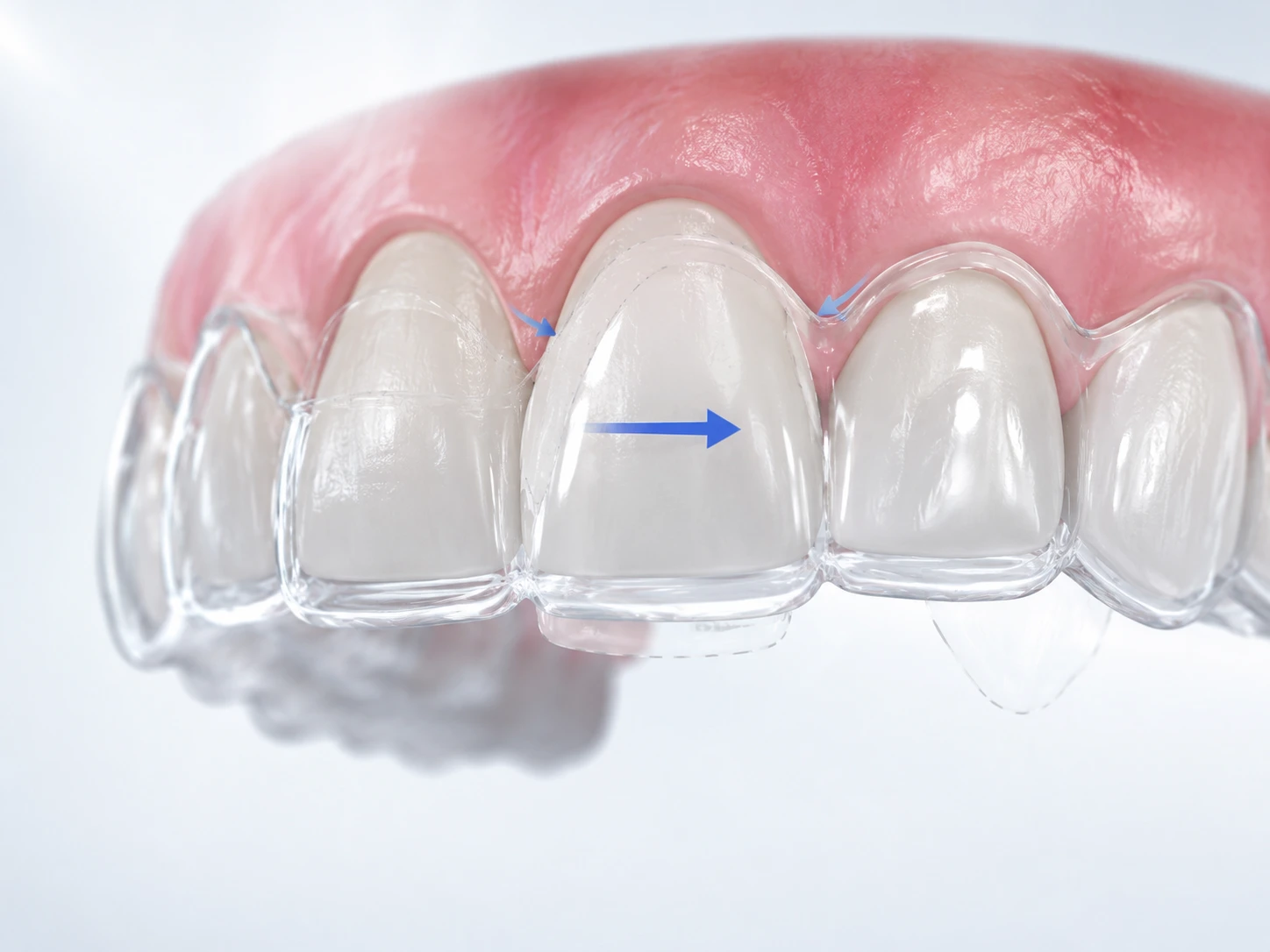 Tooth Movement Biomechanics in Clear Aligner Treatment