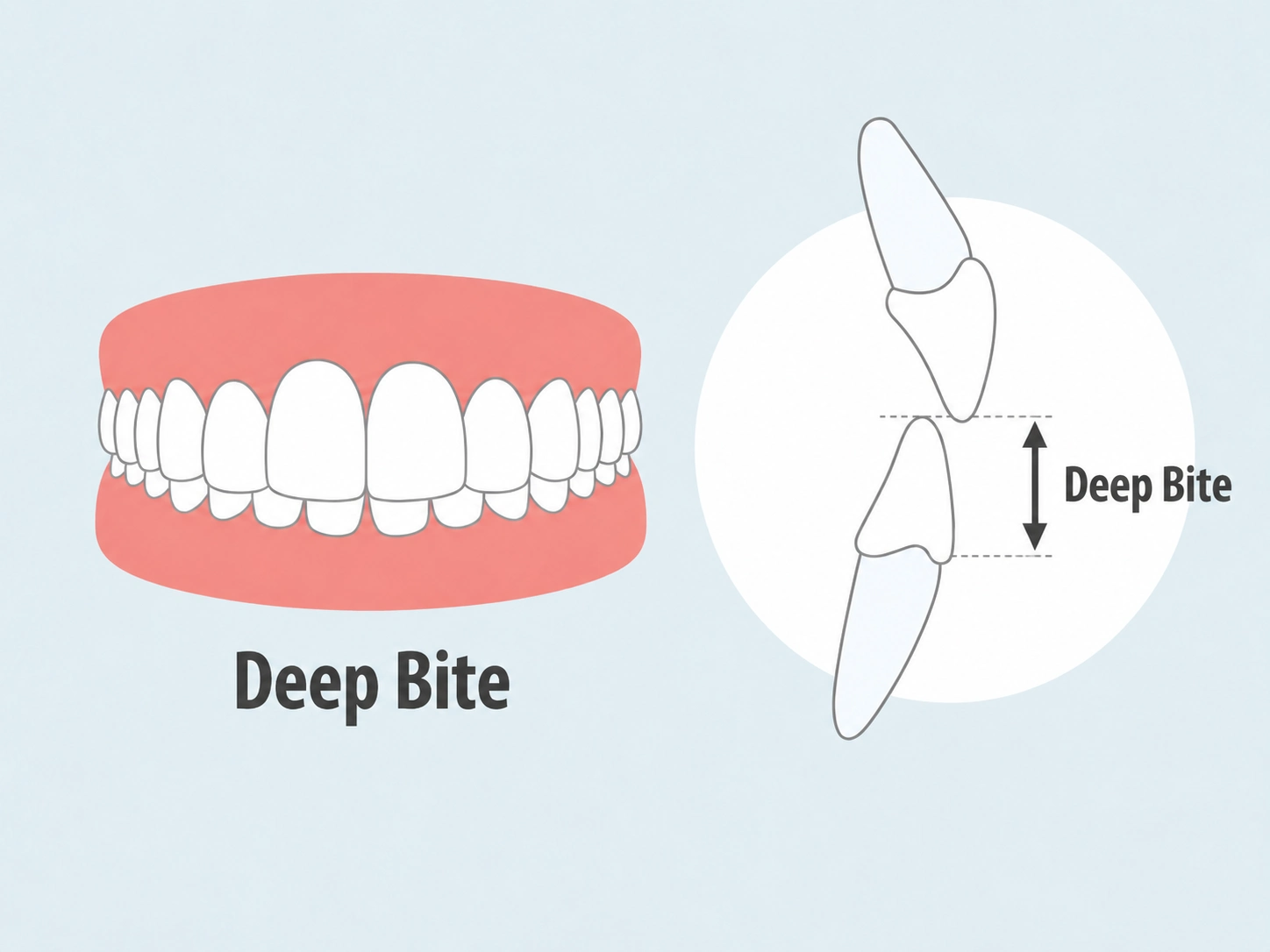 Fixing deep bite with Clear Moves Aligners