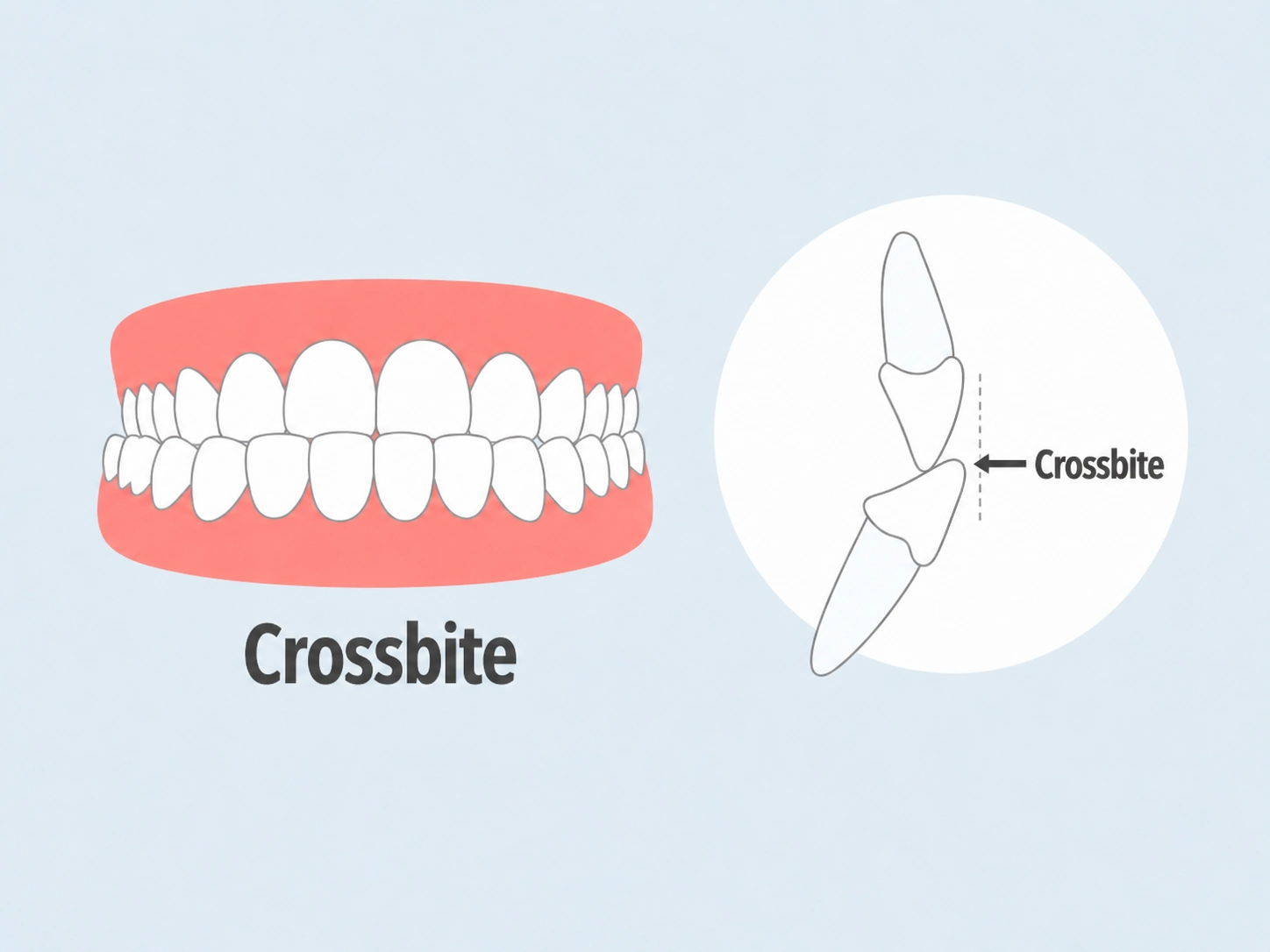 Fixing crossbite with Clear Moves Aligners