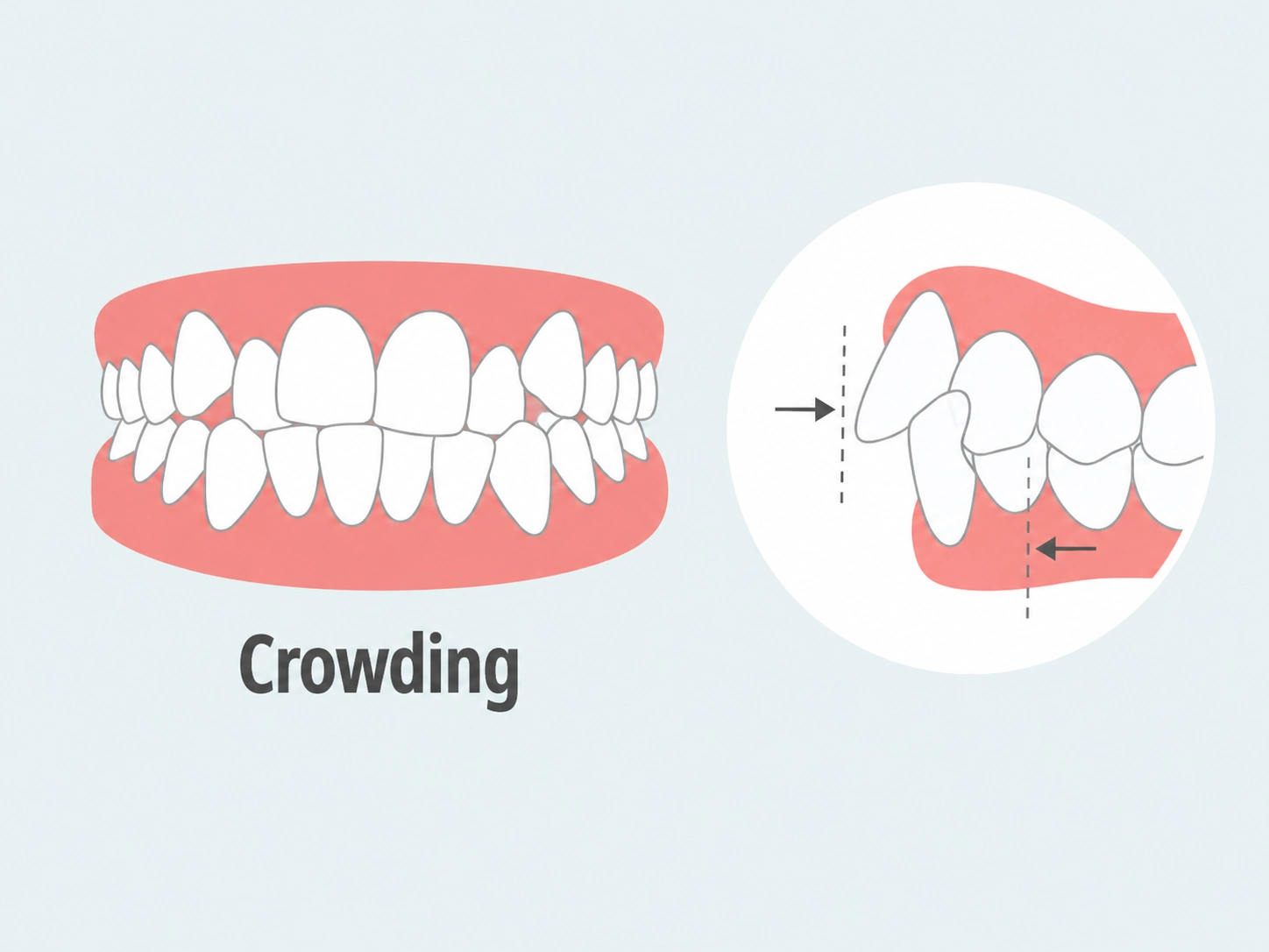 Fixing crowding with Clear Moves Aligners