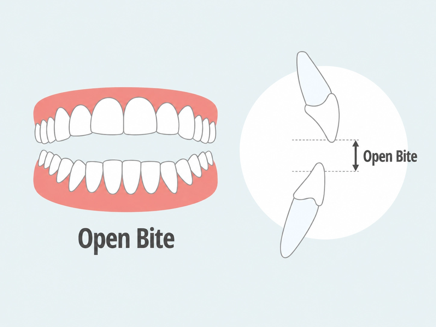 Fixing open bite with Clear Moves Aligners
