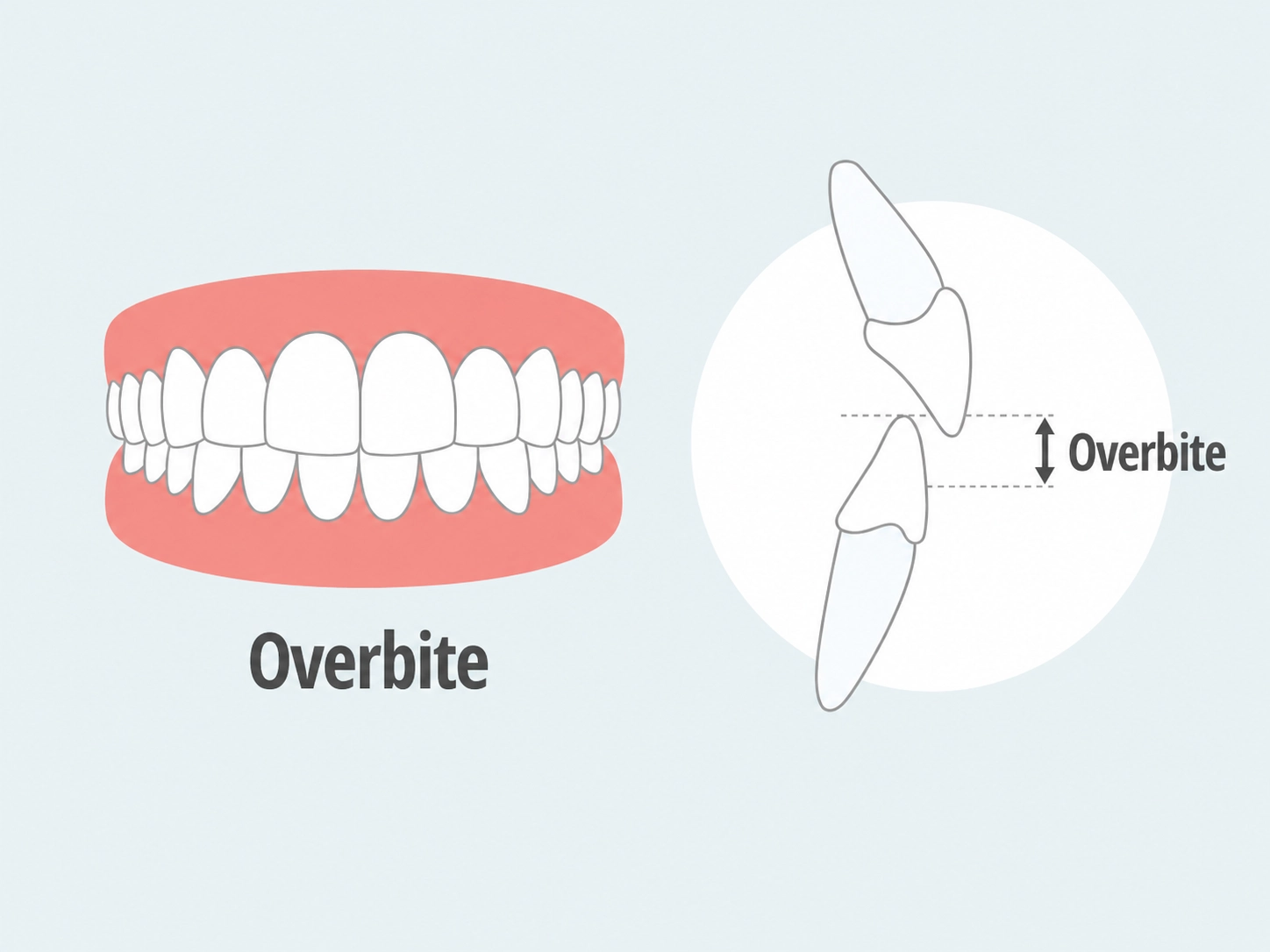 Fixing overbite with Clear Moves Aligners
