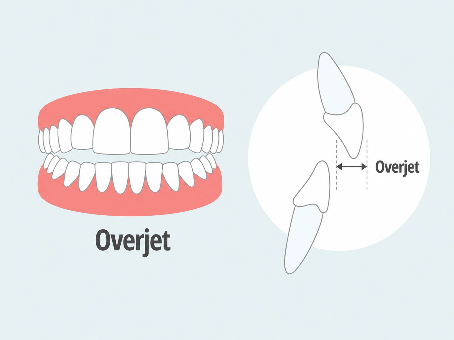 Fixing overjet with Clear Moves Aligners