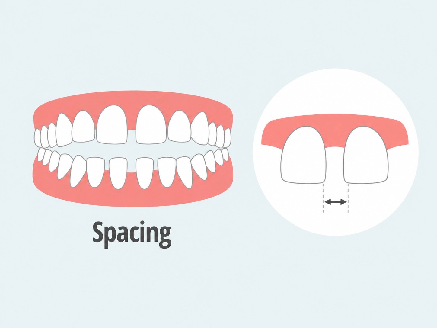 Fixing spacing with Clear Moves Aligners