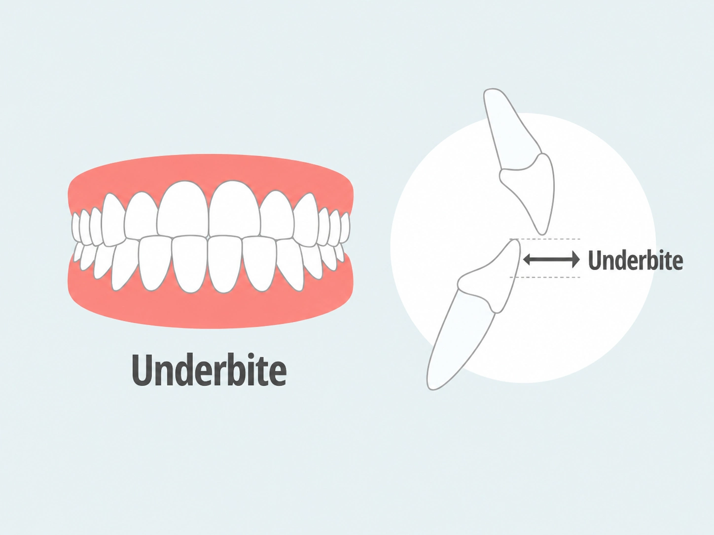 Fixing underbite with Clear Moves Aligners
