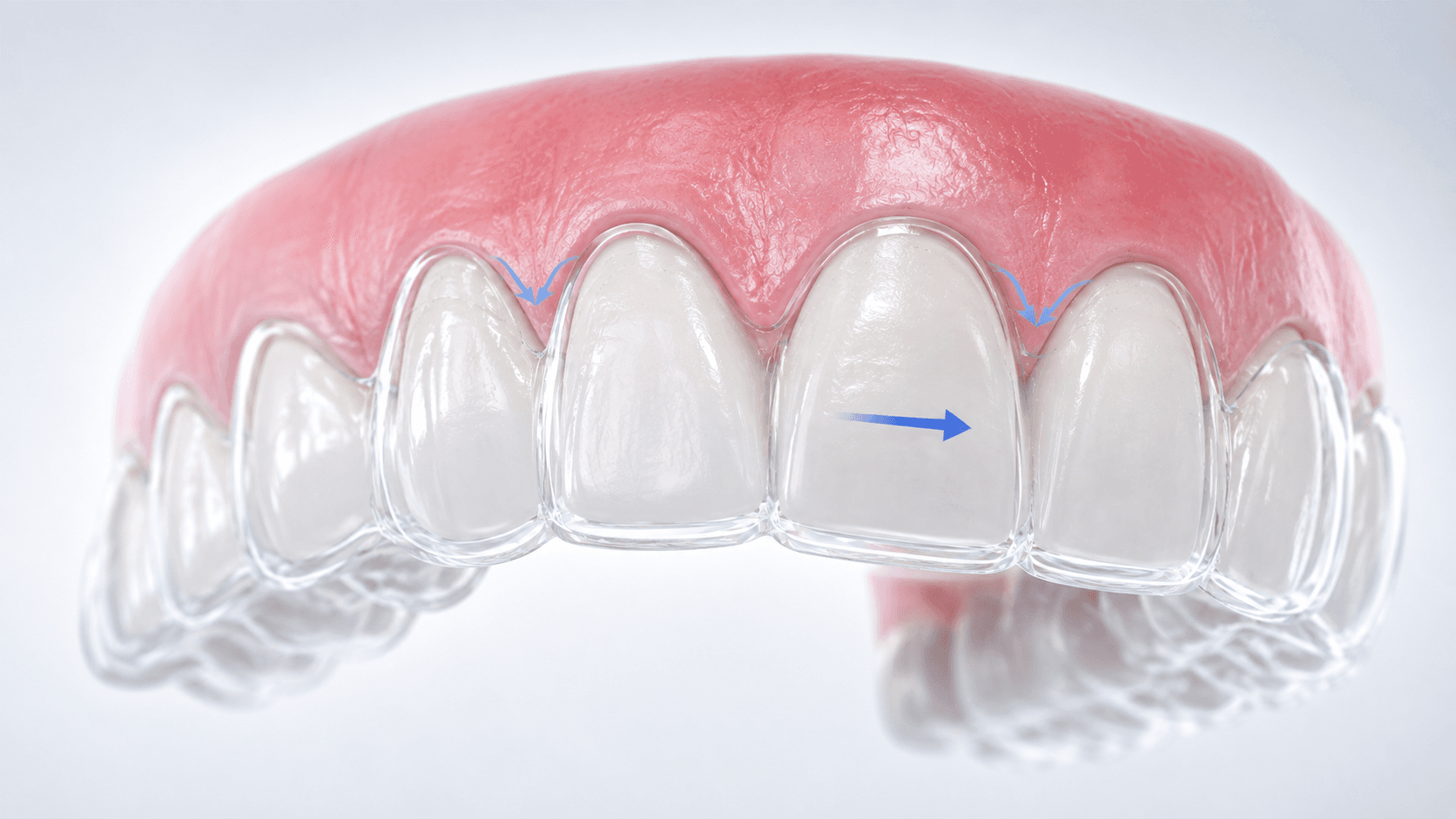 Oral Health Benefits of Straight Teeth | Beyond Looks