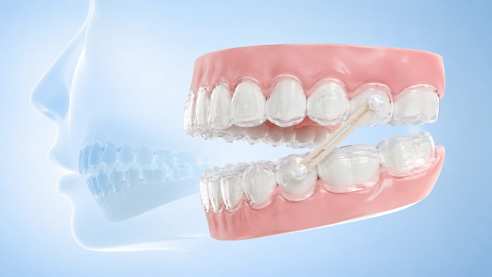 Class II Correction with Clear Aligners: Elastics, Precision Cuts and Mandibular Advancement