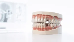 extraction-complex-clear-aligners-thumbnail-white-small-jawextraction-complex-clear-aligners-thumbnail-white-small-jaw